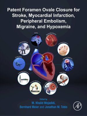 cover image of Patent Foramen Ovale Closure for Stroke, Myocardial Infarction, Peripheral Embolism, Migraine, and Hypoxemia